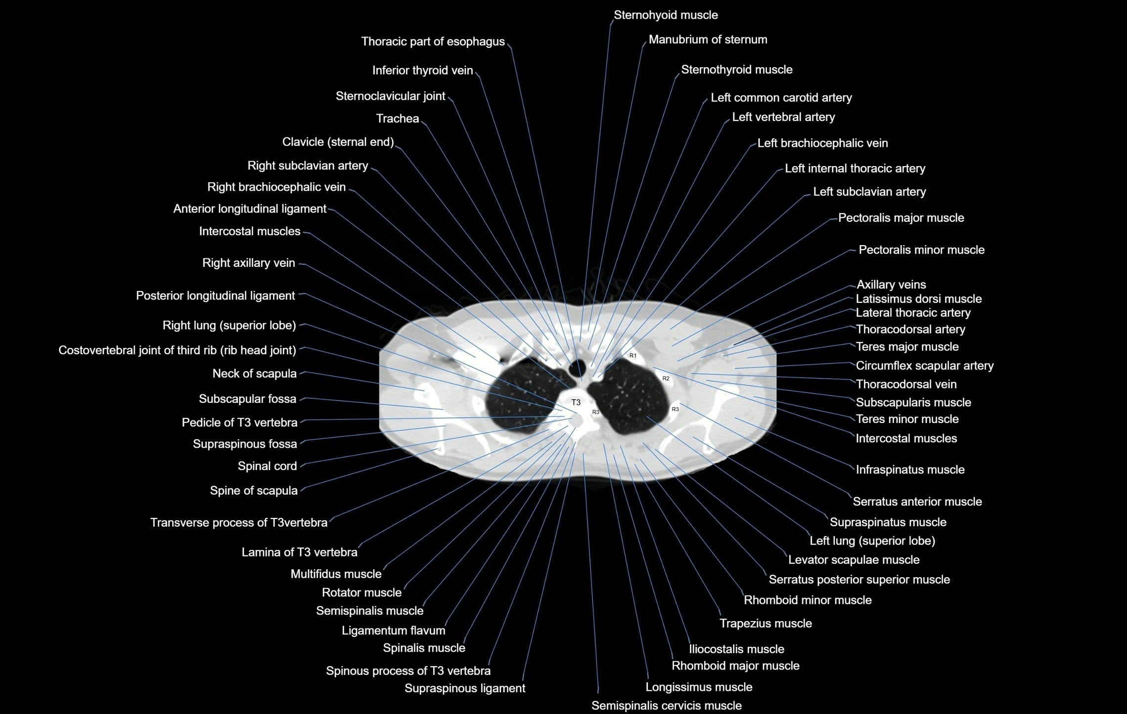 CT chest (thorax) lung window window labelled axial cross sectional anatomy radiology image-00017.webp